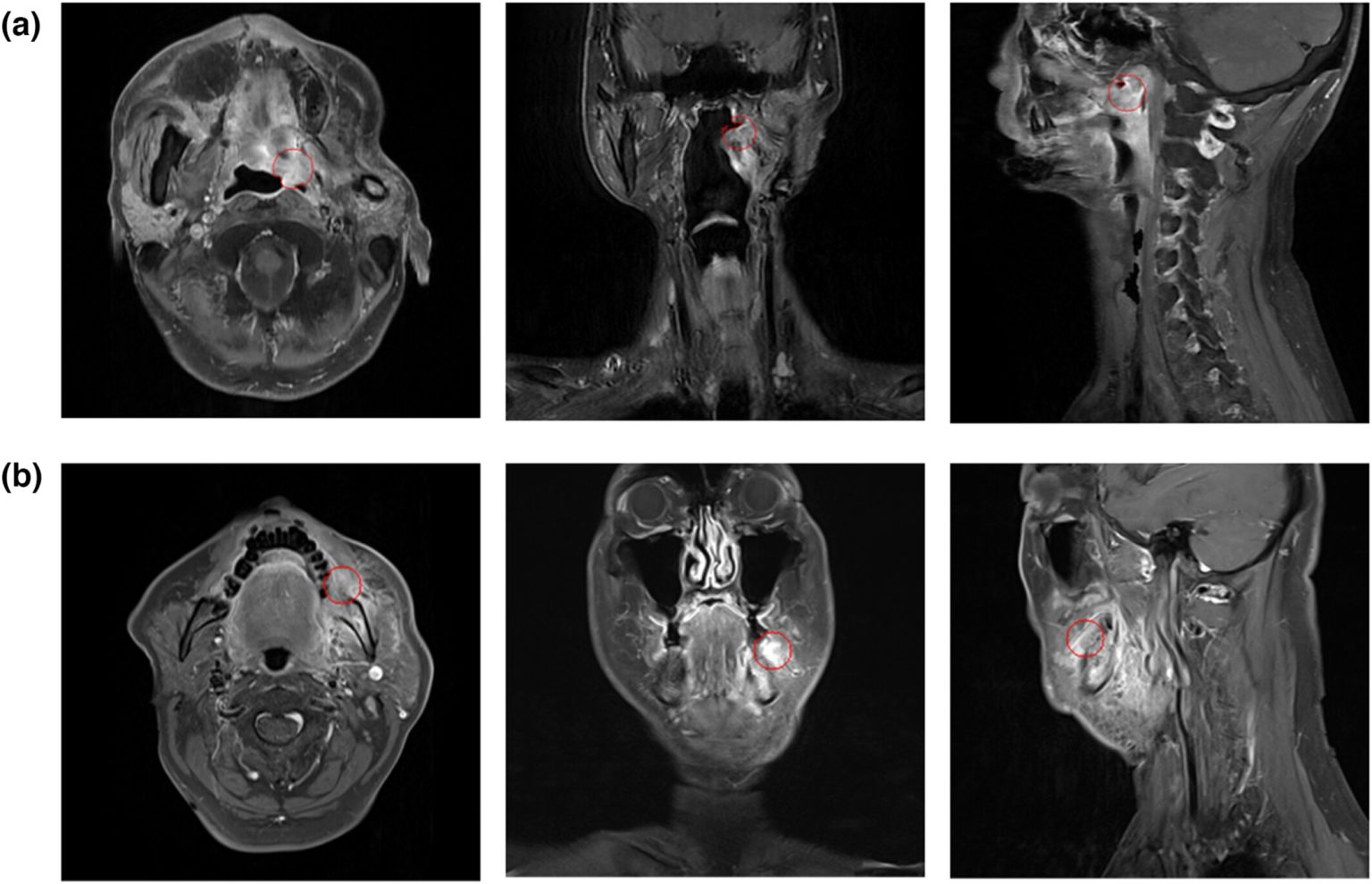 Radiomic biomarkers for platinum-refractory head and neck cancer in the era of immunotherapy